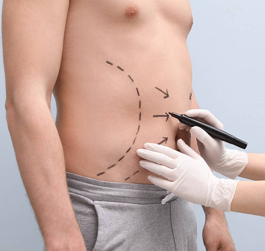 abdomen liposuction nyc