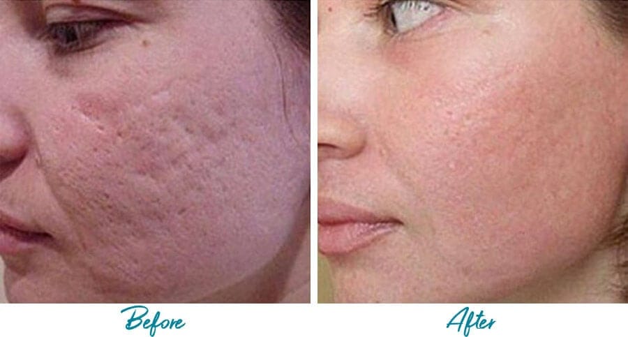 acne scar removal nyc before and after photo 02