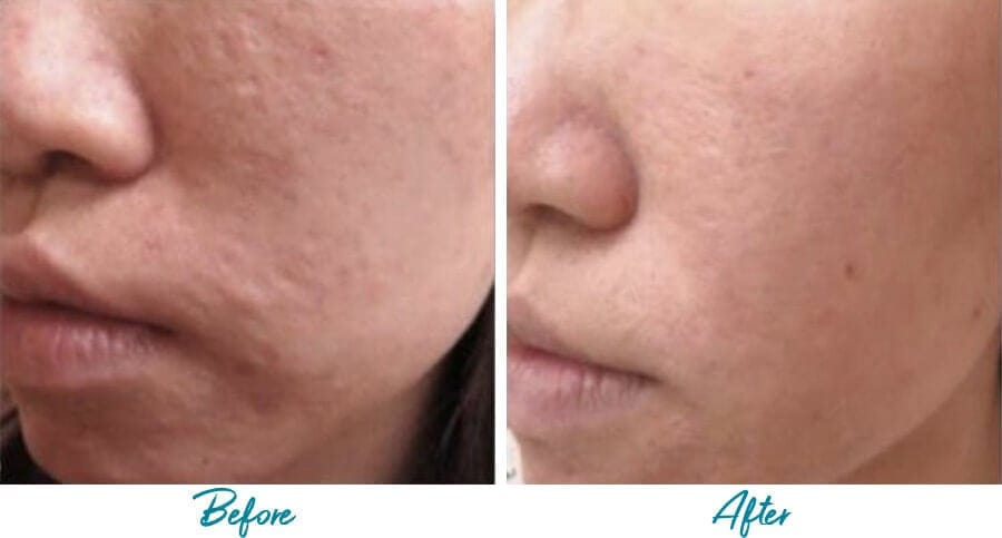 acne scar removal nyc before and after photo 06