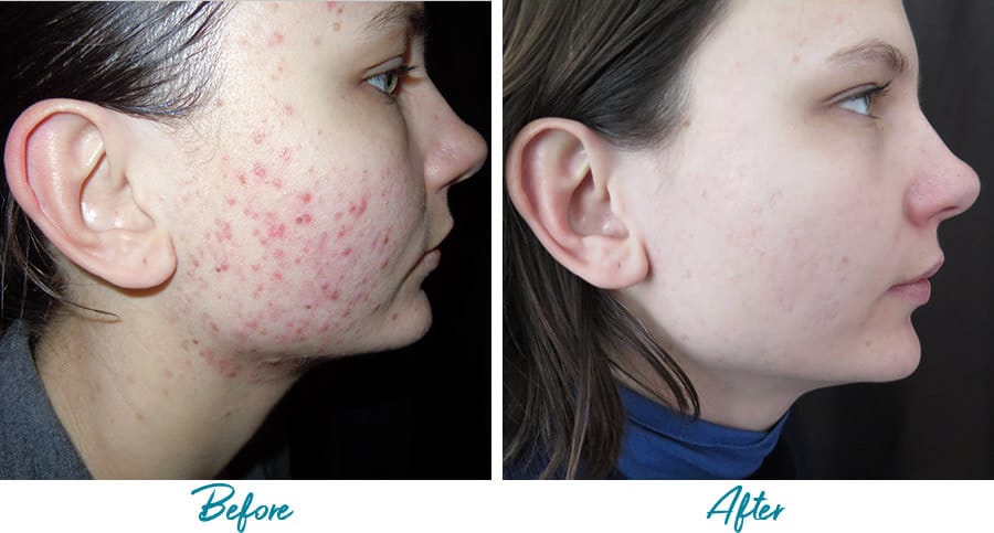 acne scar removal nyc before and after photo 09