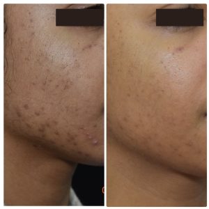 Acne Scars Before & After Gallery Patient 122206997 Image 