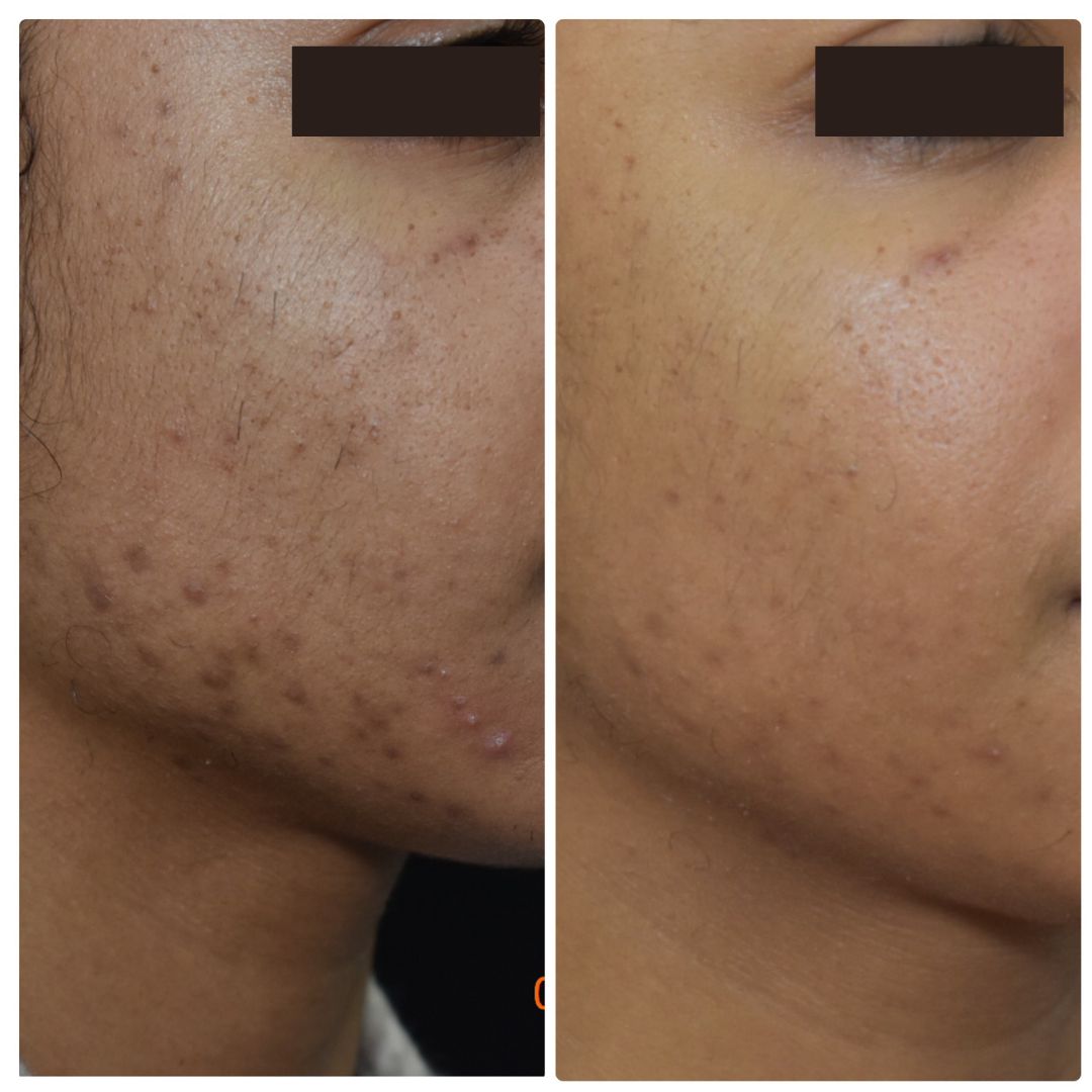 Acne Scars Before & After Gallery Patient 122206997 Image