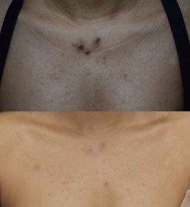 Acne Scars Before & After Gallery Patient 149342166 Image