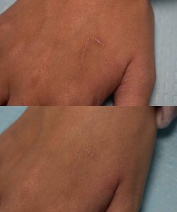 Acne Scars Before & After Gallery Patient 149342167 Image