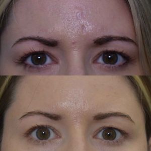 Acne Scars Before & After Gallery Patient 149342168 Image