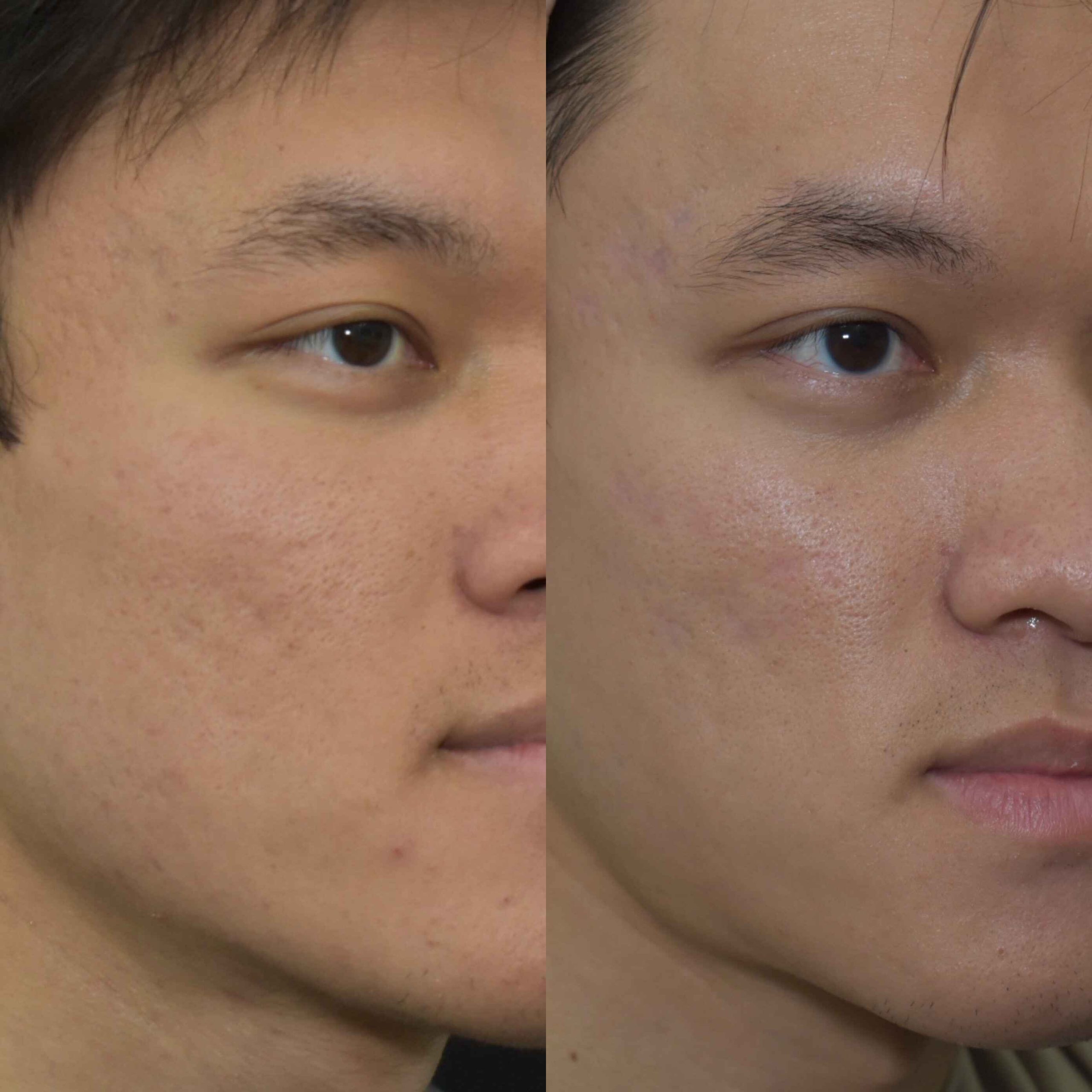 Acne Scars Before & After Gallery Patient 149342169 Image