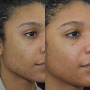 Acne Scars Before & After Gallery Patient 149342170 Image