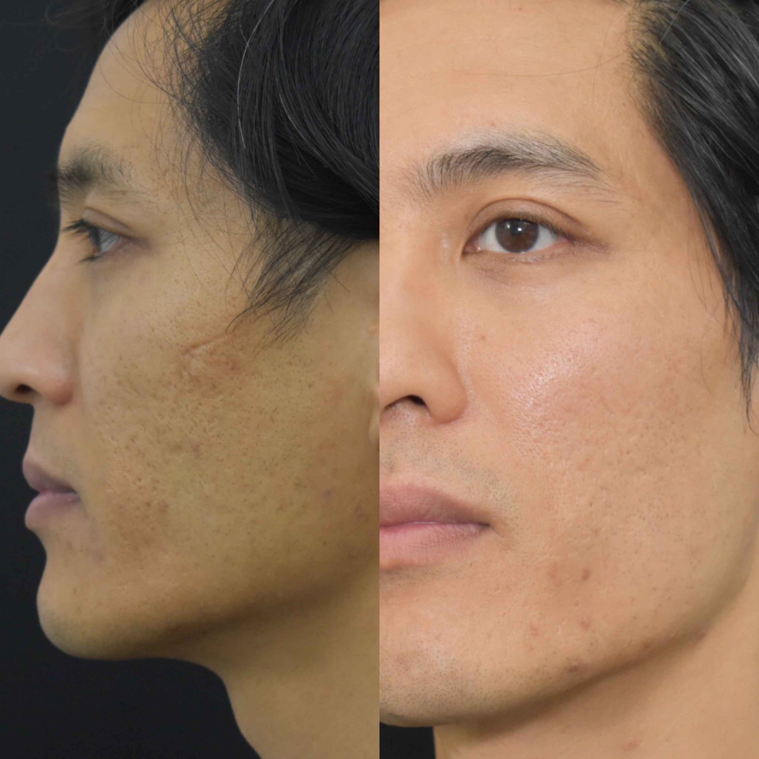 Acne Scars Before & After Gallery Patient 149342171 Image