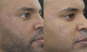 Acne Scars Before & After Gallery Patient 149342172 Image