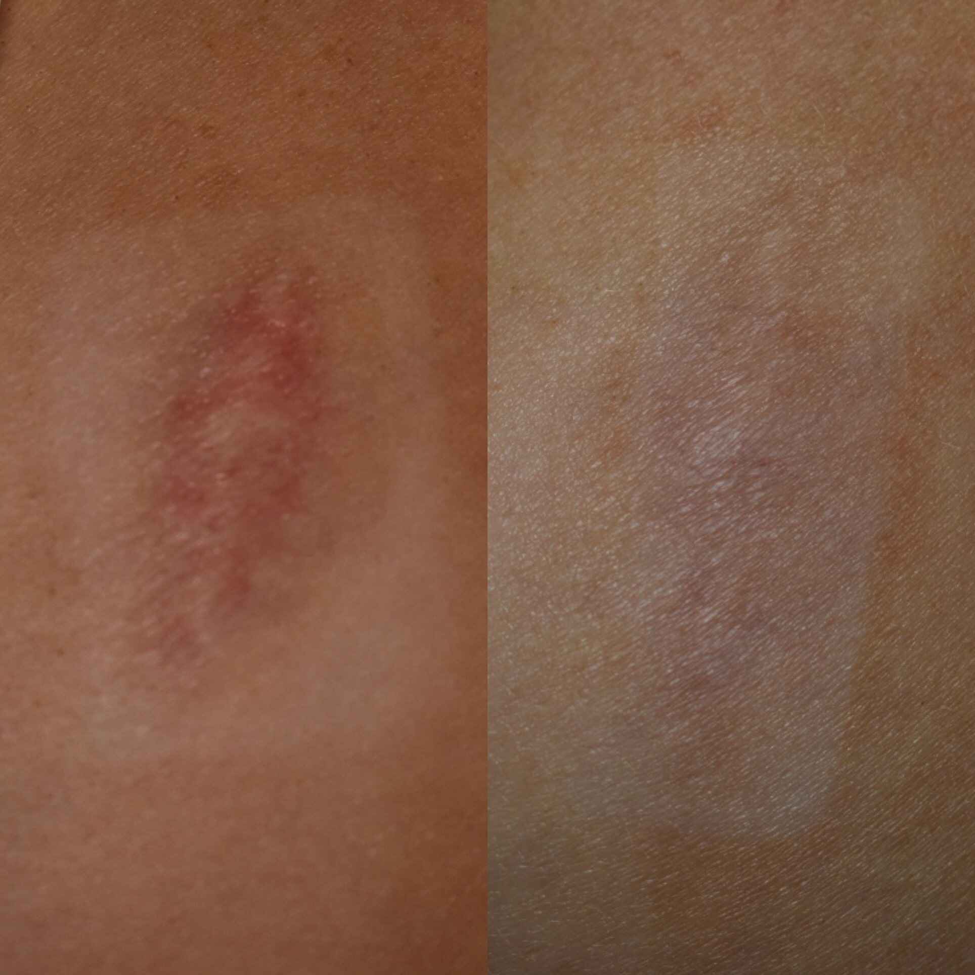 Acne Scars Before & After Gallery Patient 149342175 Image