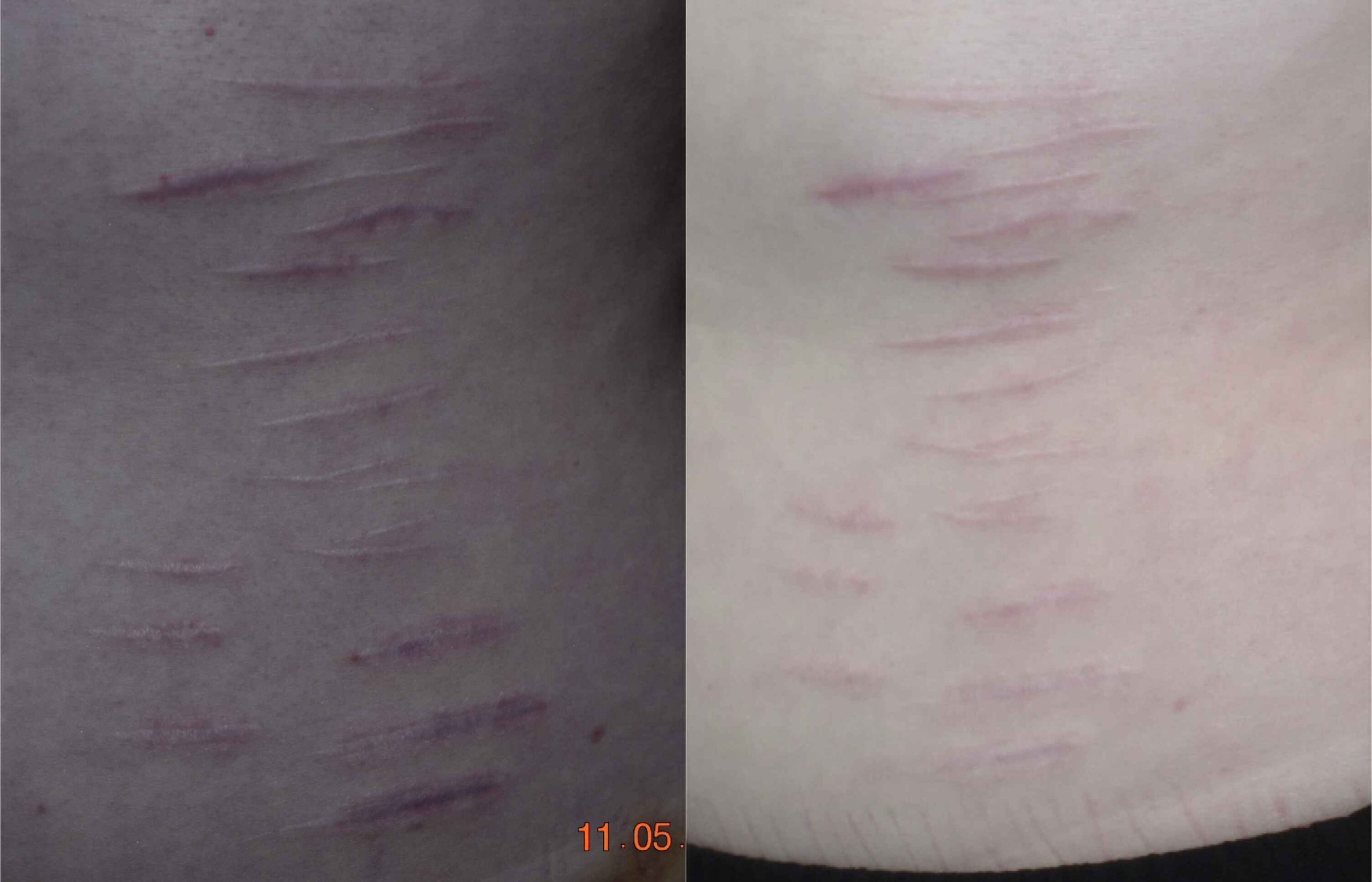 Acne Scars Before & After Gallery Patient 149342176 Image