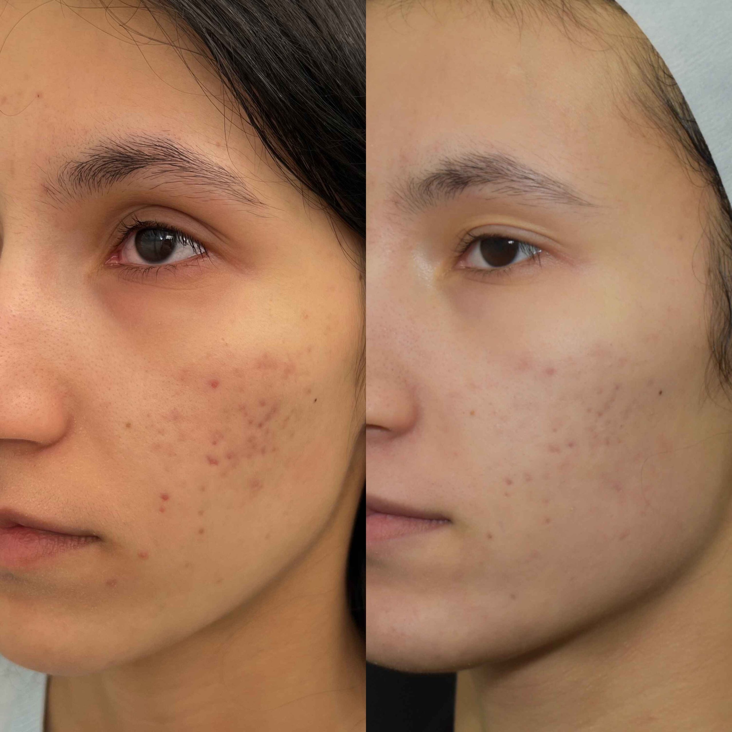 Acne Scars Before & After Gallery Patient 149342177 Image