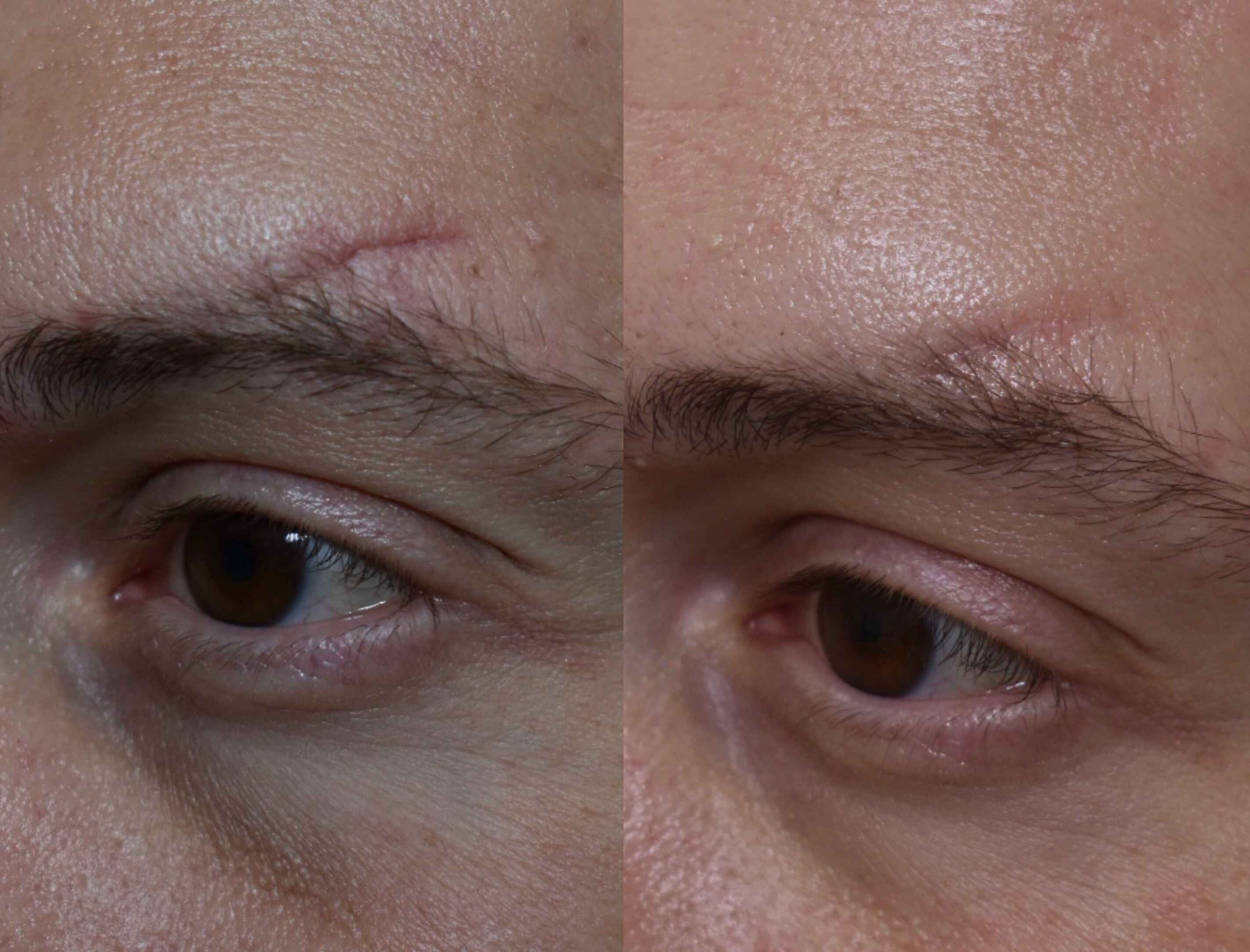 Acne Scars Before & After Gallery Patient 149342178 Image