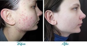 Acne Scars Before & After Gallery Patient 18616220 Image