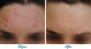 Acne Scars Before & After Gallery Patient 18616221 Image