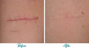 Acne Scars Before & After Gallery Patient 18616222 Image