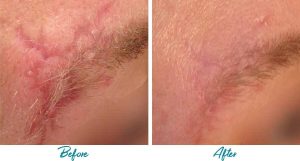 Acne Scars Before & After Gallery Patient 18616223 Image