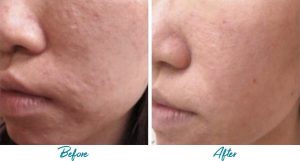 Acne Scars Before & After Gallery Patient 18616224 Image