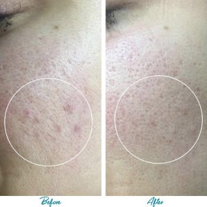 Acne Scars Before & After Gallery Patient 18616517 Image