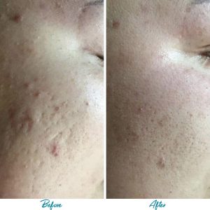 Acne Scars Before & After Gallery Patient 18616518 Image