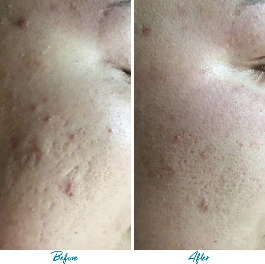 Acne Scars Before & After Gallery Patient 18616518 Image