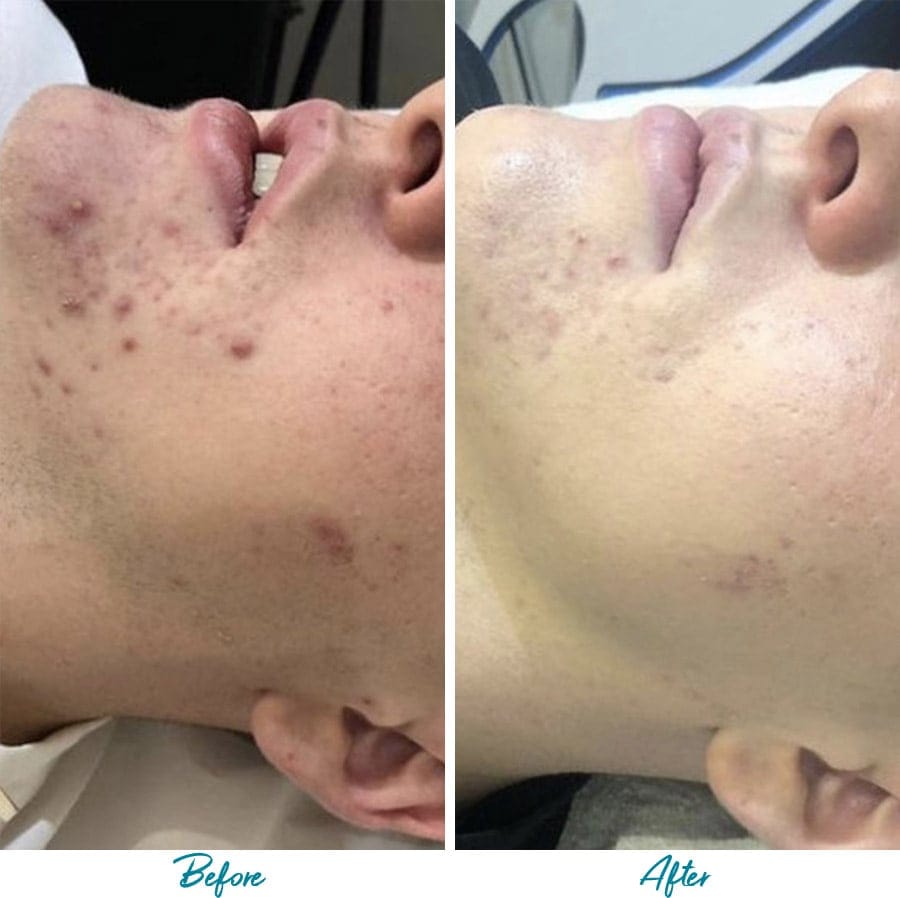 Acne Scars Before & After Gallery Patient 18616519 Image