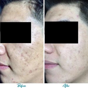 Acne Scars Before & After Gallery Patient 18616520 Image