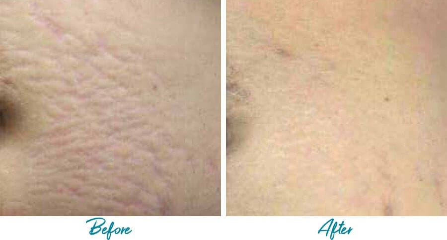 Acne Scars Before & After Gallery Patient 18616521 Image