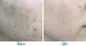 Acne Scars Before & After Gallery Patient 18616522 Image