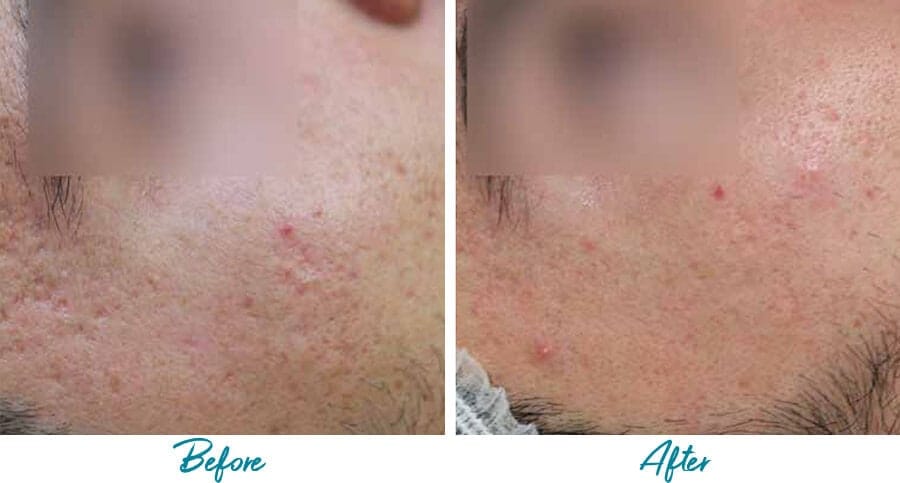 Acne Scars Before & After Gallery Patient 18616523 Image