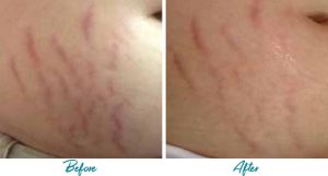 Acne Scars Before & After Gallery Patient 18616524 Image