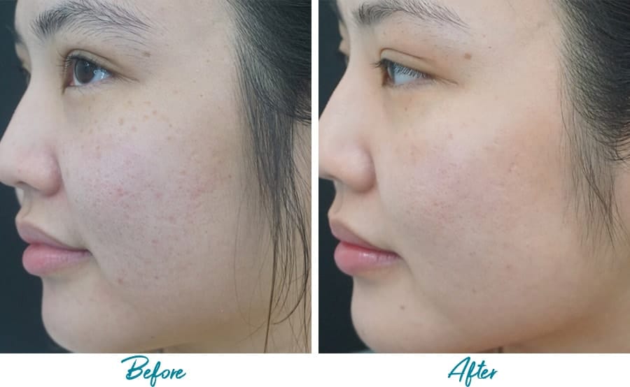 Acne Scars Before & After Gallery Patient 18616525 Image