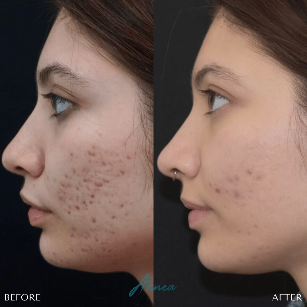 Acne Scars Before & After Gallery Patient 20905116 Image