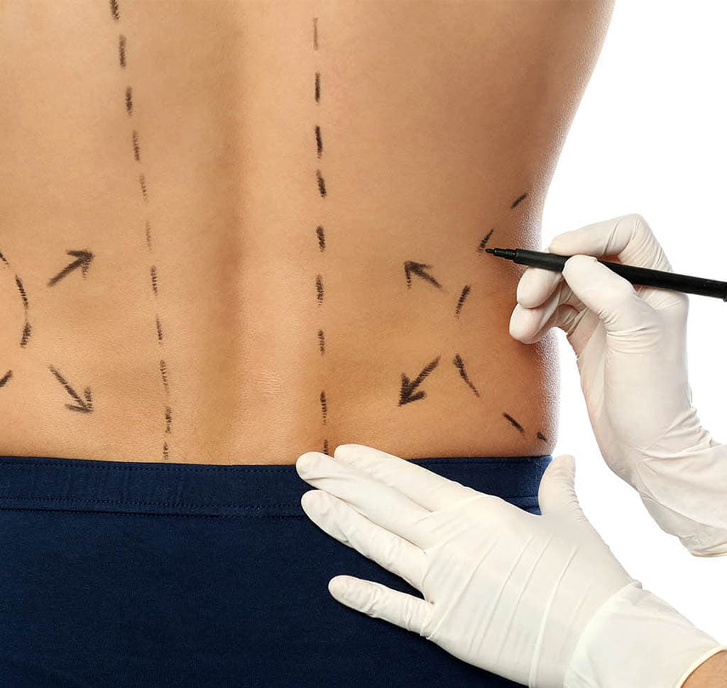 back liposuction nyc