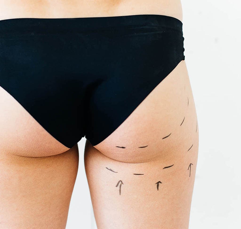 buttocks liposuction nyc