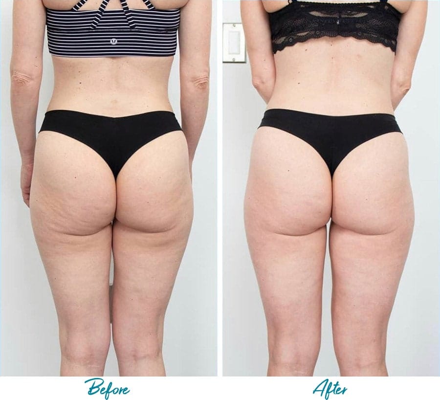 cellulite treatment nyc before after photos 3