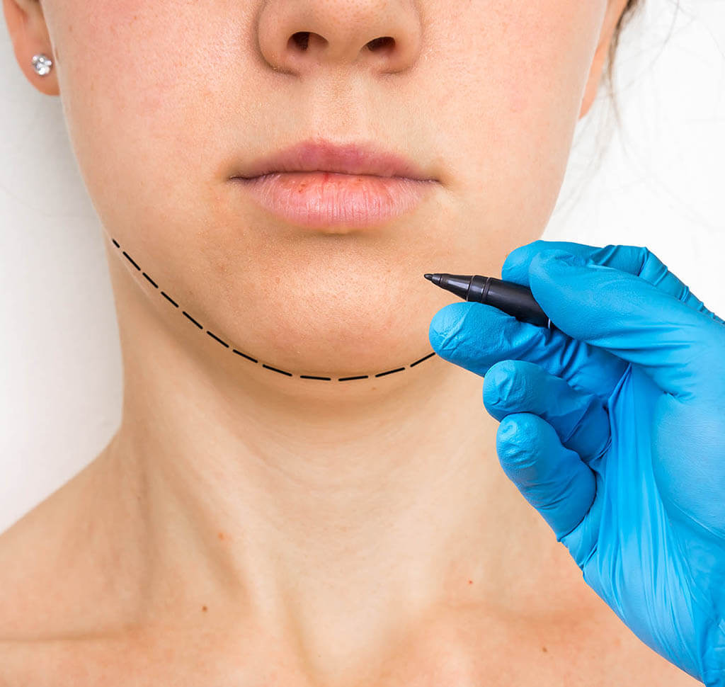 chin liposuction nyc