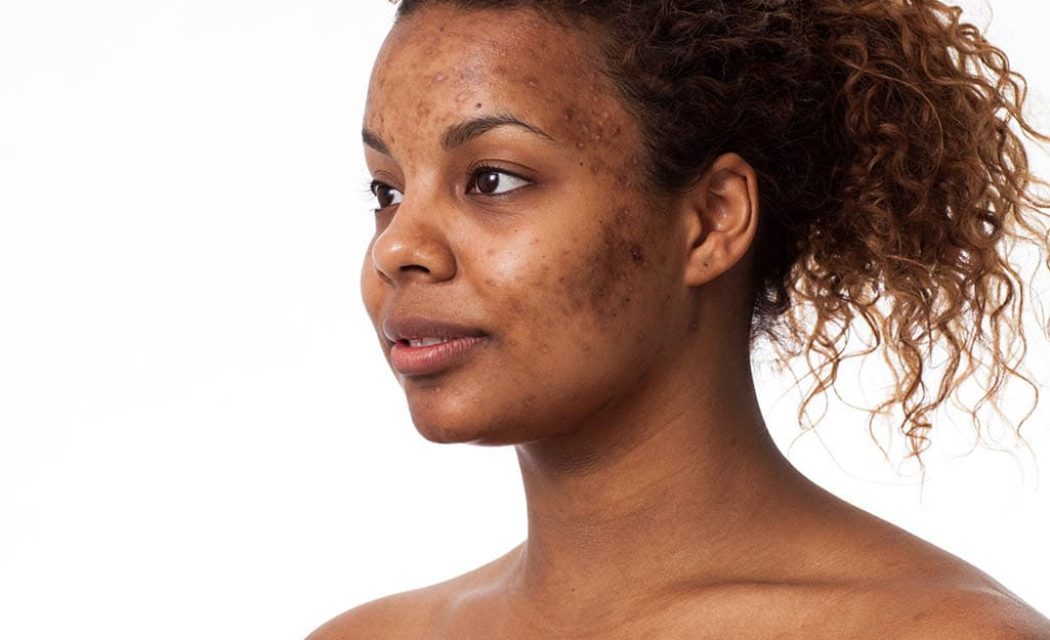 deep acne scars nyc