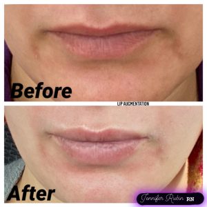 Fillers Before & After Gallery - Patient 122596979 - Image