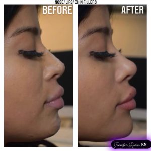 Fillers Before & After Gallery Patient 122596981 Image