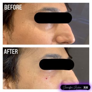 Fillers Before & After Gallery Patient 122596982 Image