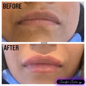 Fillers Before & After Gallery Patient 122596983 Image