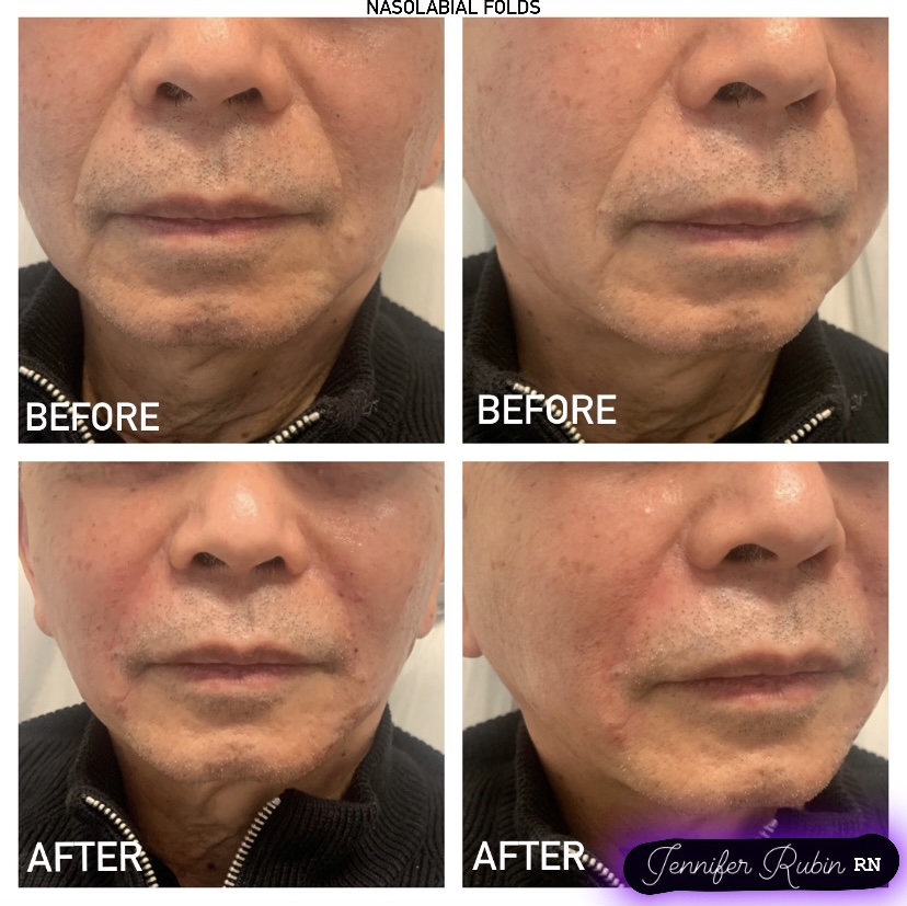 Fillers Before & After Gallery Patient 122596984 Image