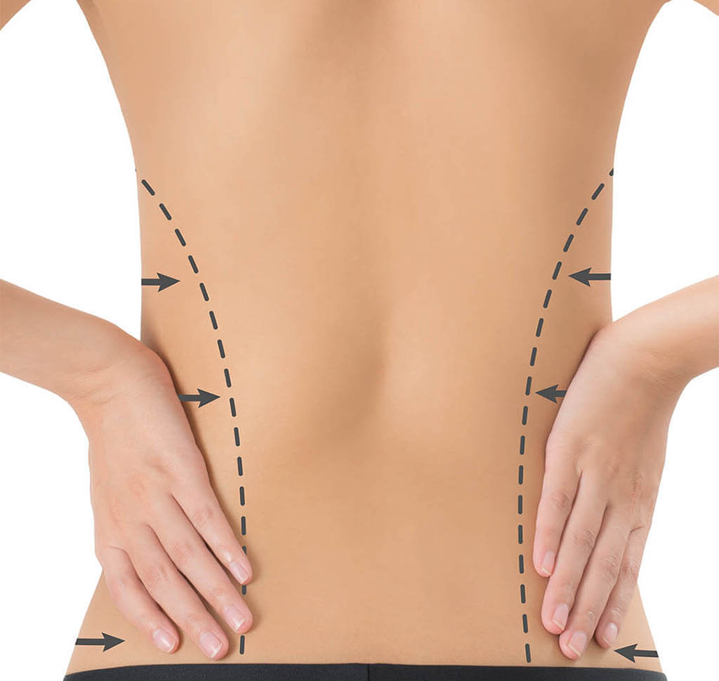 hips liposuction nyc