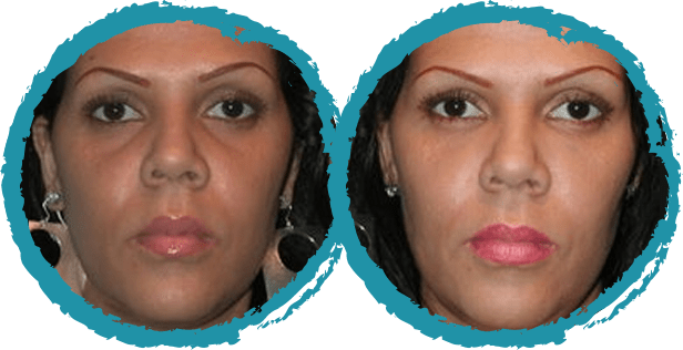 juvederm before and after 1