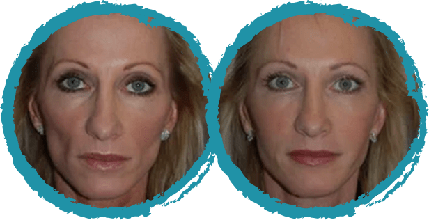 juvederm before and after 2