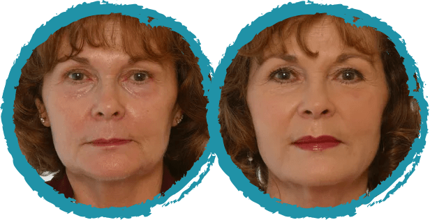 juvederm before and after 3