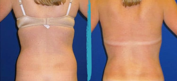 liposuction nyc before and after pictures 01