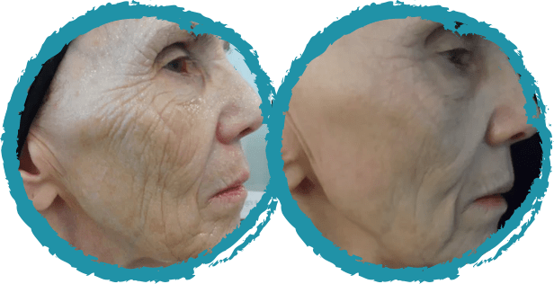 microneedling before and after 1