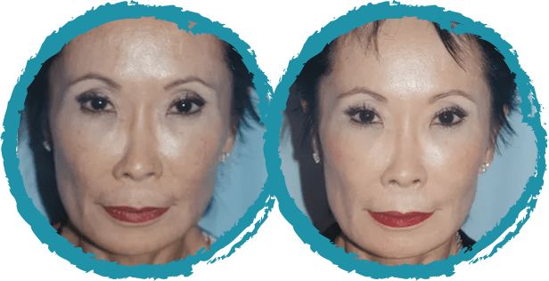 microneedling before and after 2